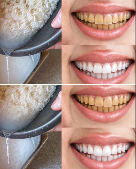 Blanqueamiento dental en casa