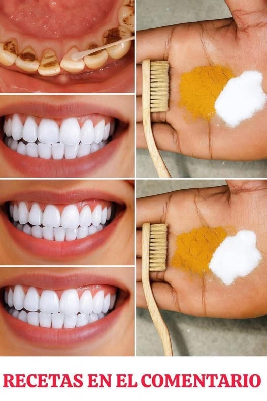 Blanqueamiento Dental Casero: Consigue Dientes Más Blancos Rápidamente