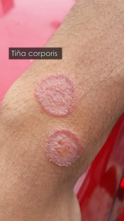 ¿Qué es esa mancha en tu piel? Descubre sus posibles causas