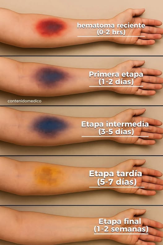 ¿Qué Significan los Moratones Inexplicables en el Cuerpo?