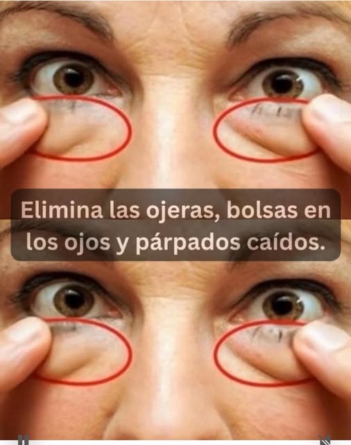 Descubre el Truco Casero Más Efectivo para Eliminar las Ojeras
